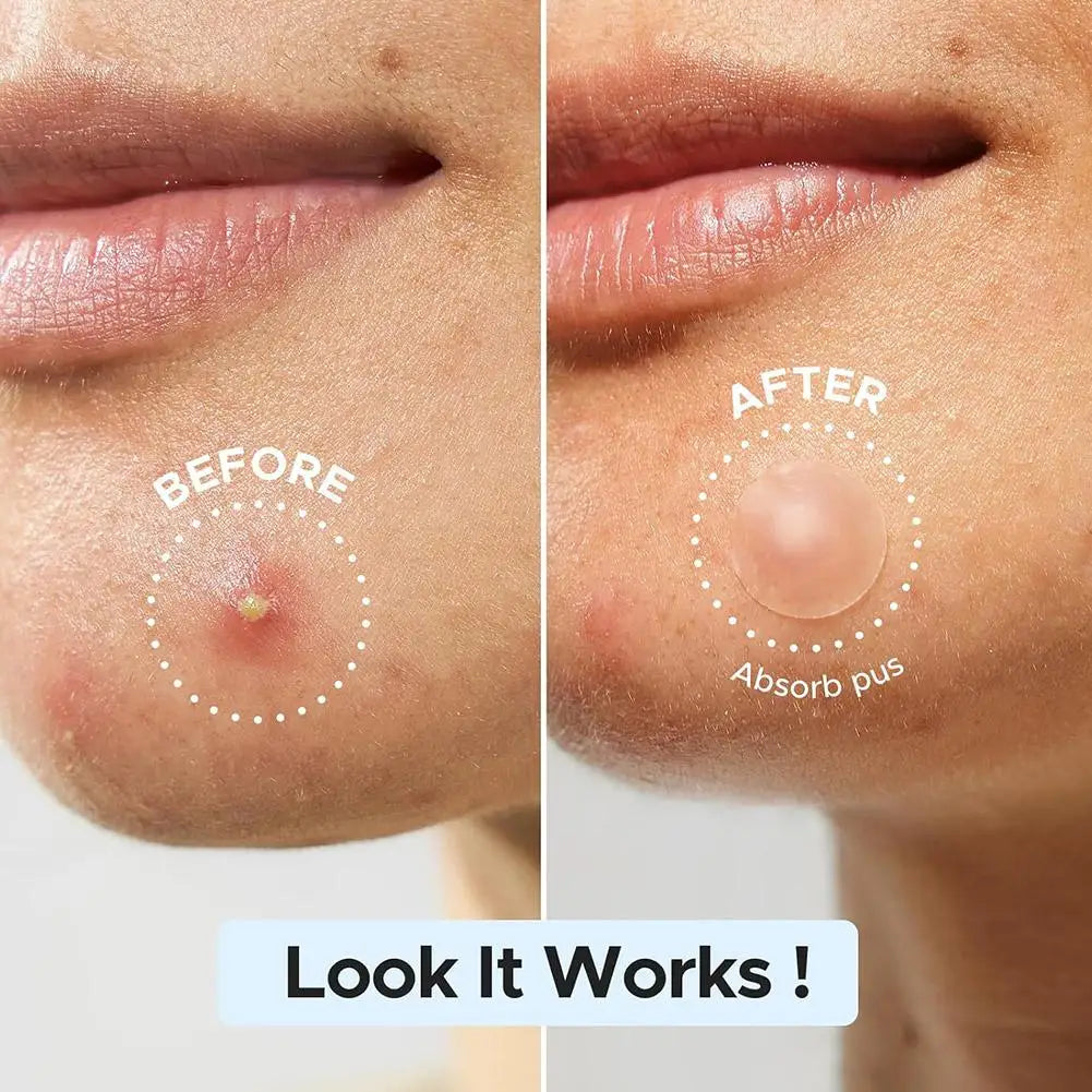 Acne Fighter Patches