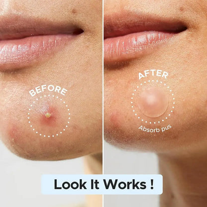Acne Fighter Patches