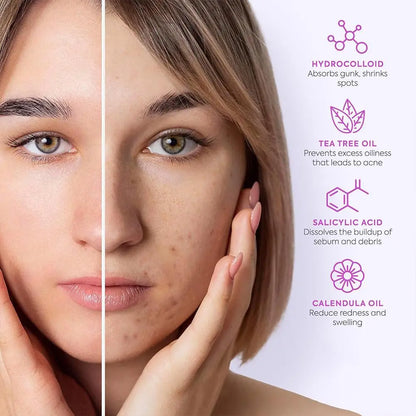 Acne Fighter Patches